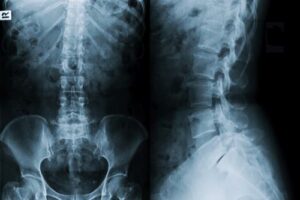 How Much are Spinal Cord injury cases worth?
