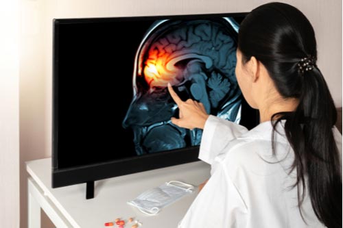 Santa Ana traumatic brain injury lawyer concept, doctor touching brain scan image