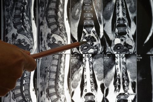 Image is of a doctor's hand pointing to an injury in a spinal cord MRI image, concept of Fullerton spinal cord injury lawyer