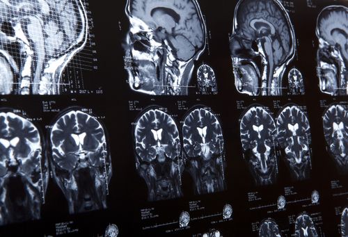 Image is of MRI brain scans concept of Fullerton brain injury lawyer