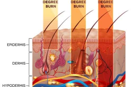 first, second and third degree burns on skin