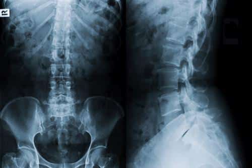 X-ray of spine, spinal cord injury